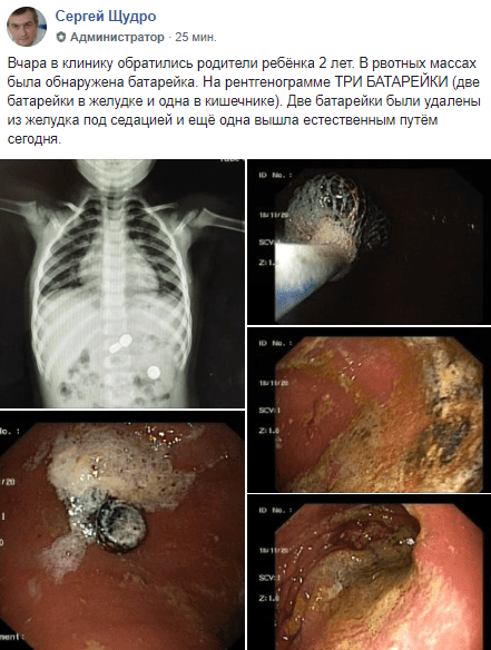 В Днепре спасали малыша, проглотившего 3 батарейки