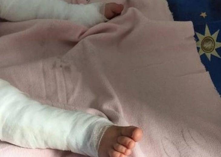 В Днепре спасают 3-летнюю девочку, у которой обожжено 50% тела