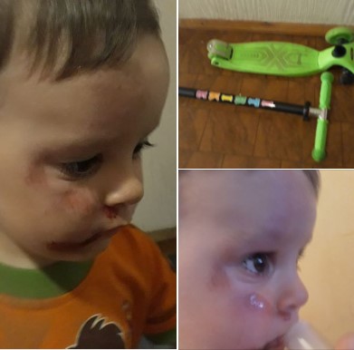 Кровь, обломки самоката и дикий крик ребенка: в Днепре на большой скорости девушка на электросамокате сбила малыша (ФОТО)