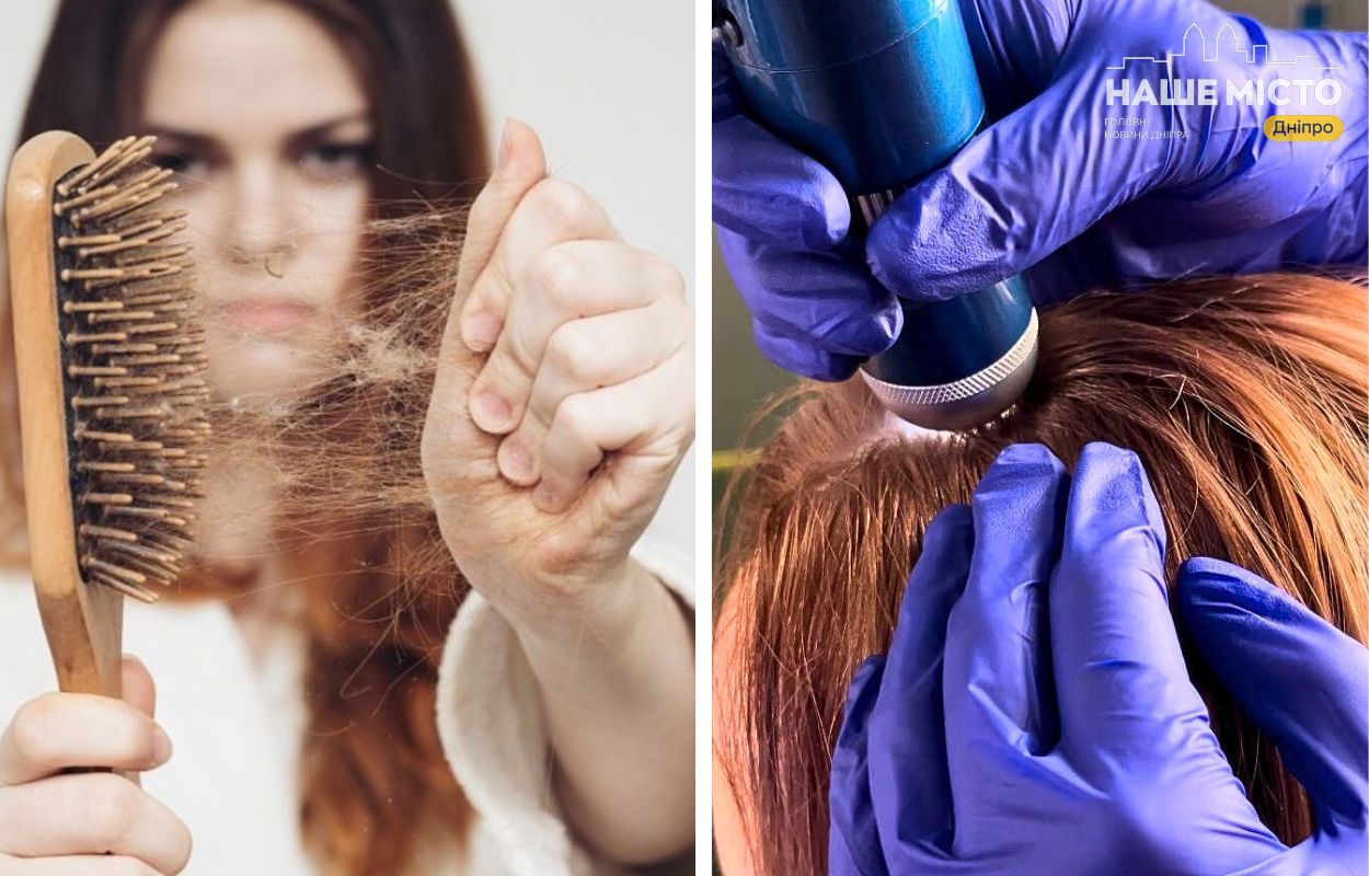 Як боротися з сезонним випадінням волосся в Дніпрі?