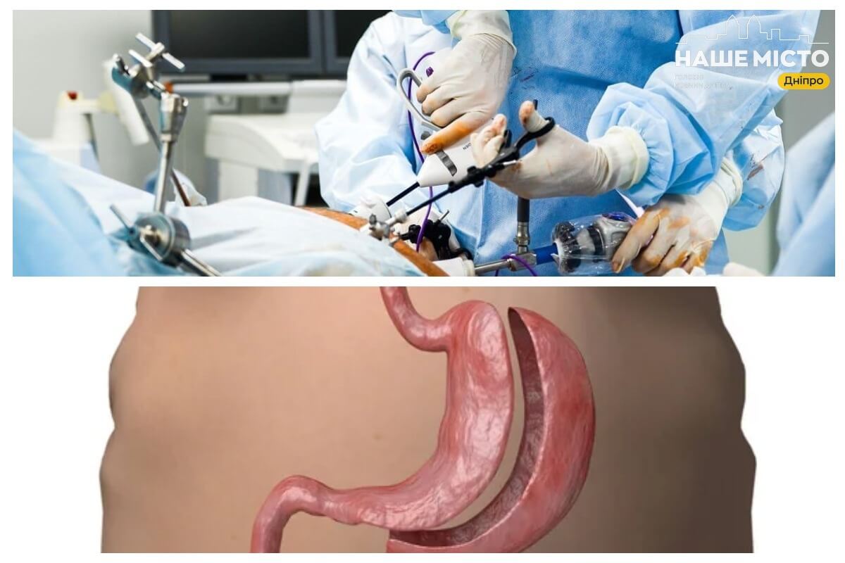 Вартість баріатричної операції у Дніпрі: огляд цін та послуг